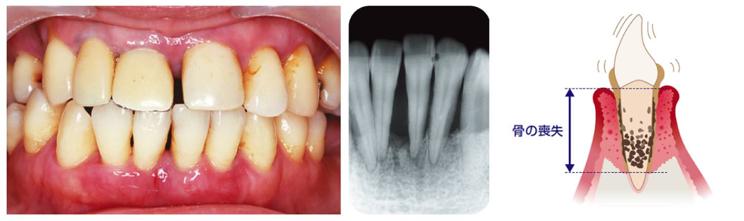 歯周病の進行3